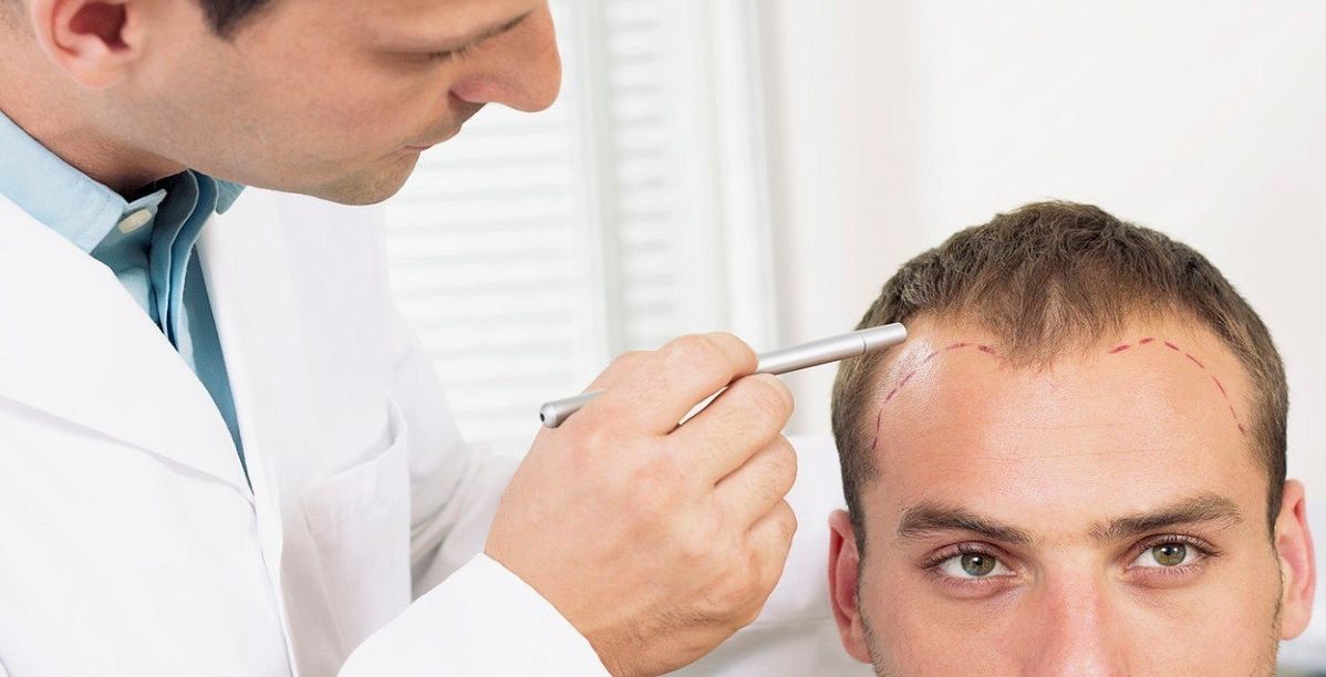 ماهو افضل مركز لزراعة الشعر في تركيا