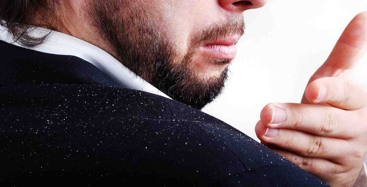 علاج القشرة في الشعر