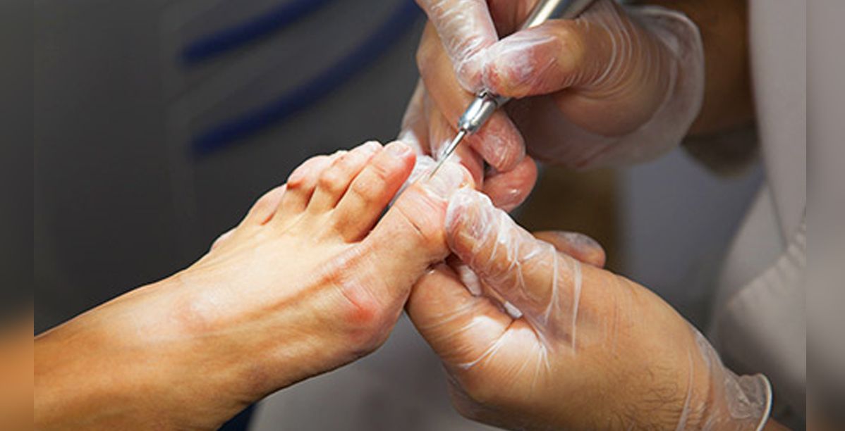 علاج الفطريات بين اصابع القدم