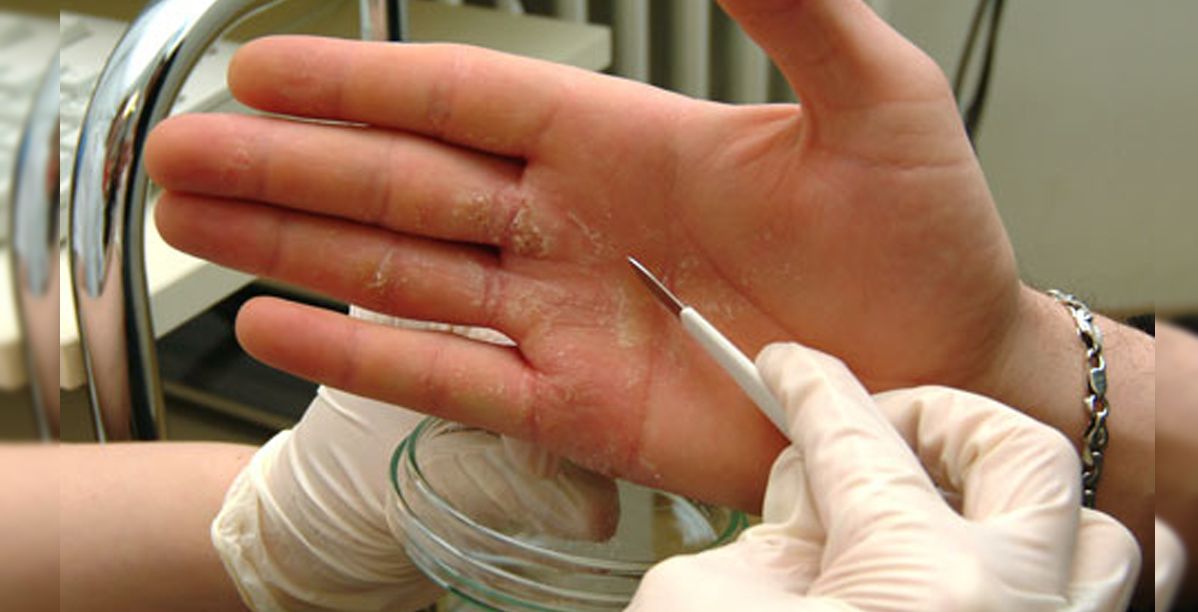 علاج اكزيما اليدين