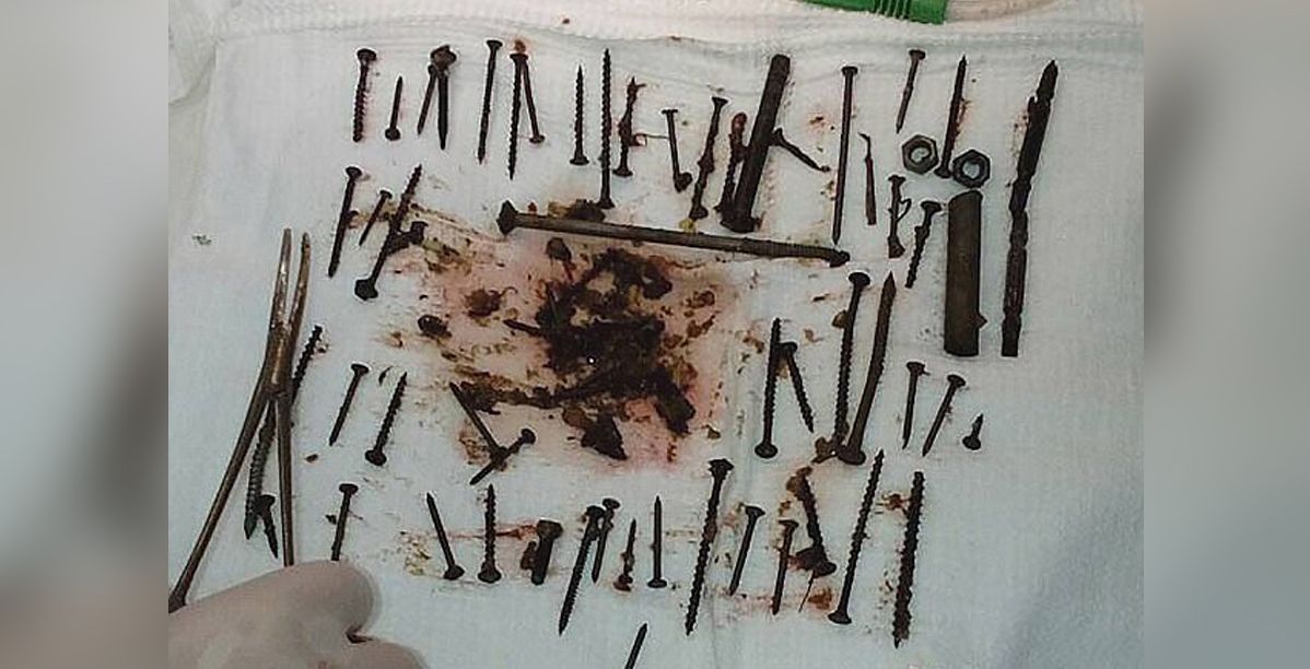 152 قطعة معدنية في معدة سيدة روسية