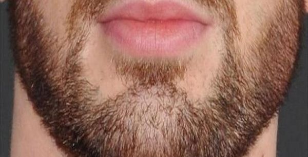 طرق علاج فراغات الذقن