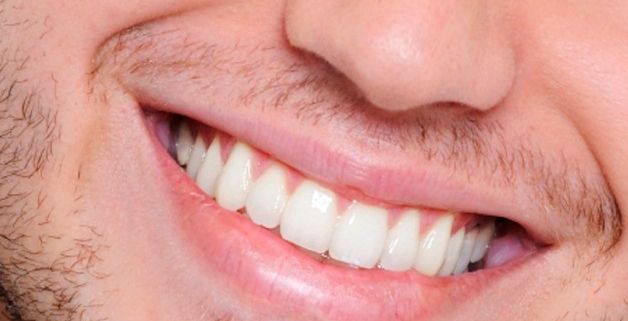 3 طرق طبيعية لتبييض الاسنان