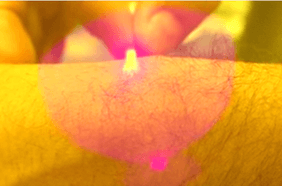 شفرة حلاة جديدة تعمل على الليزر