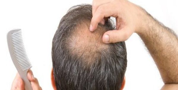 علاج تساقط الشعر عند الرجال