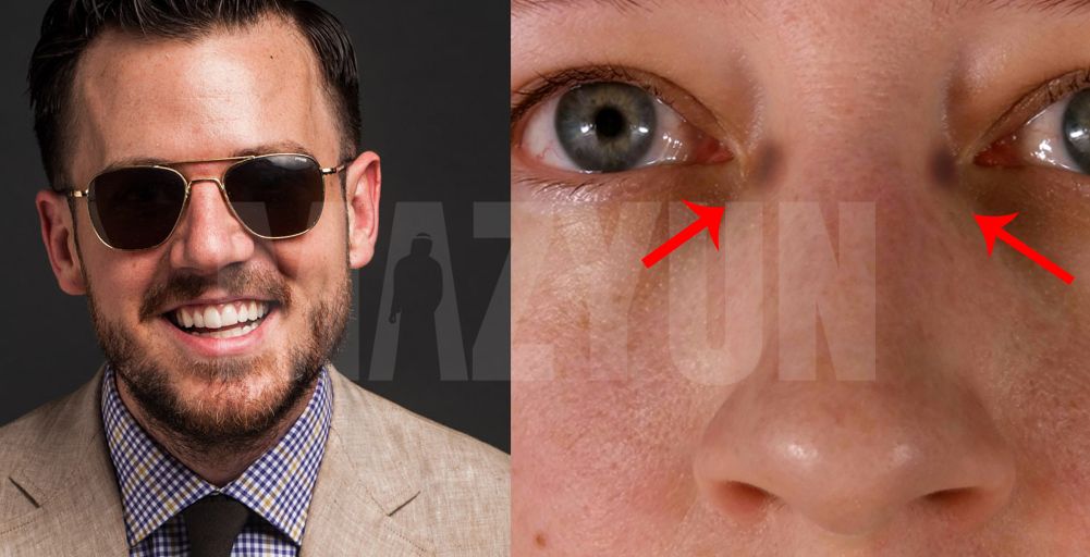 4 طرق للتحلص من اثار النظارات على الوجه