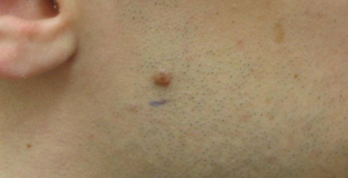3 طرق طبيعية للتلخص من الثاليل والدهنيات