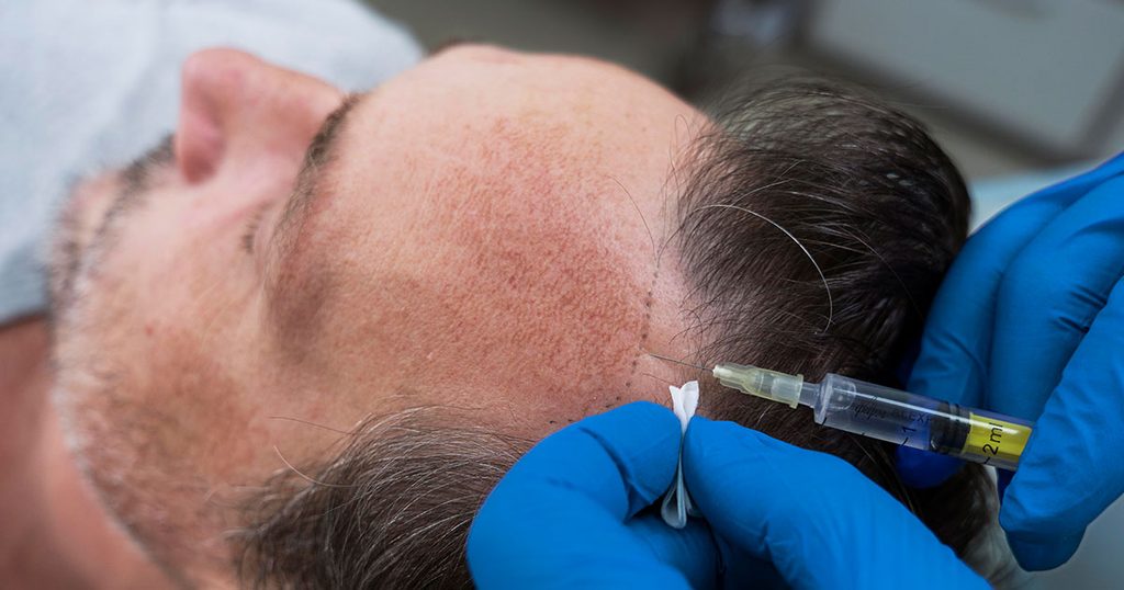 عيوب زراعة الشعر