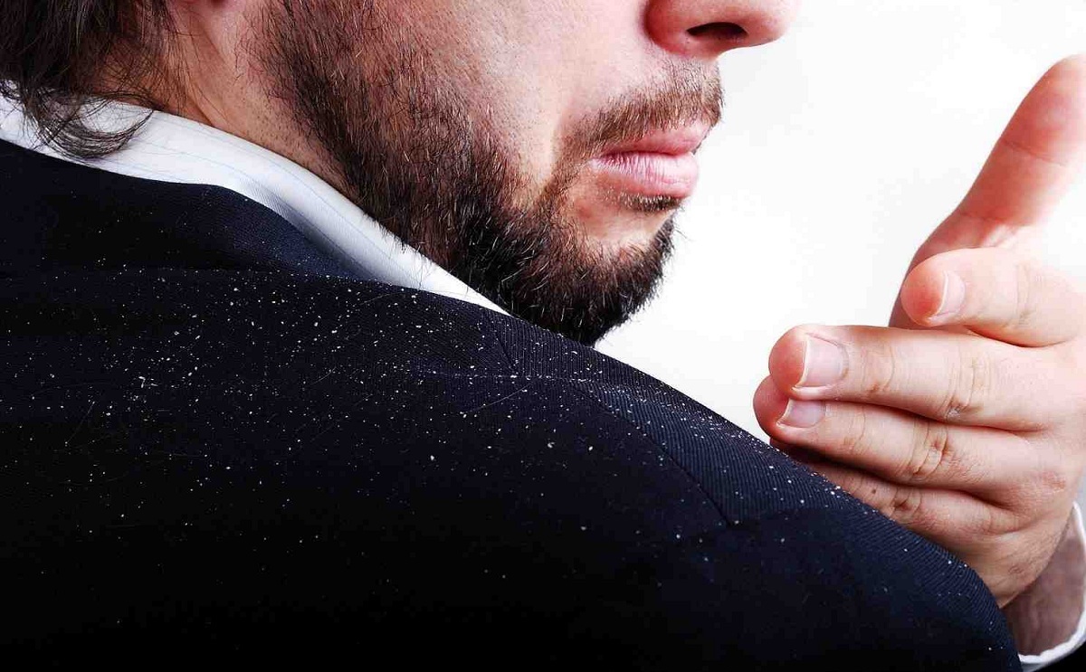 علاج القشرة في الشعر