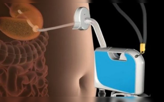 مضخة المعدة تساعدك على فقدان الوزن