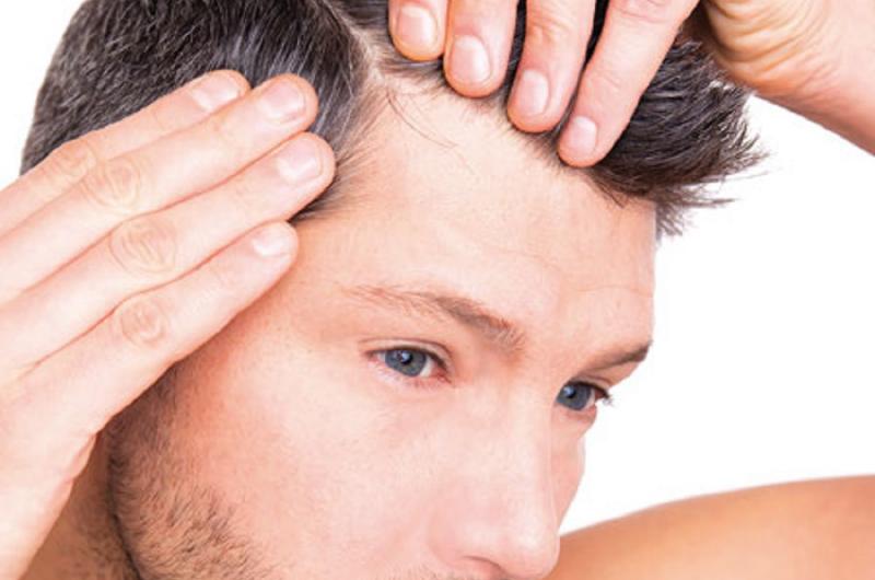 طرق زراعة الشعر
