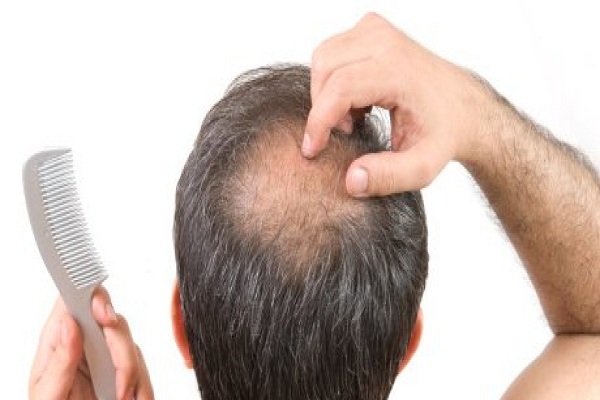 علاج تساقط الشعر عند الرجال